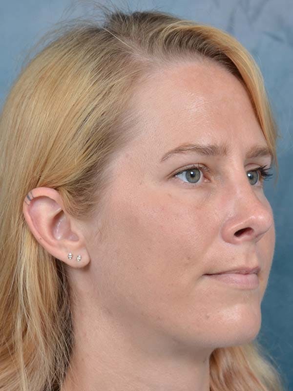 Rhinoplasty Before & After Gallery - Patient 121959740 - Image 6