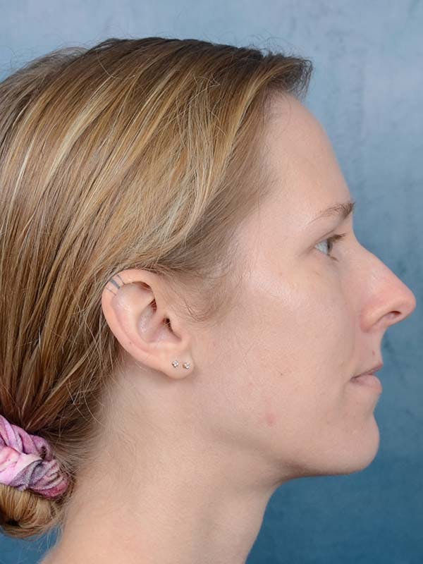 Rhinoplasty Before & After Gallery - Patient 121959740 - Image 7