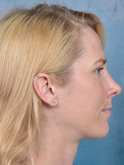 Rhinoplasty Before & After Gallery - Patient 121959740 - Image 8