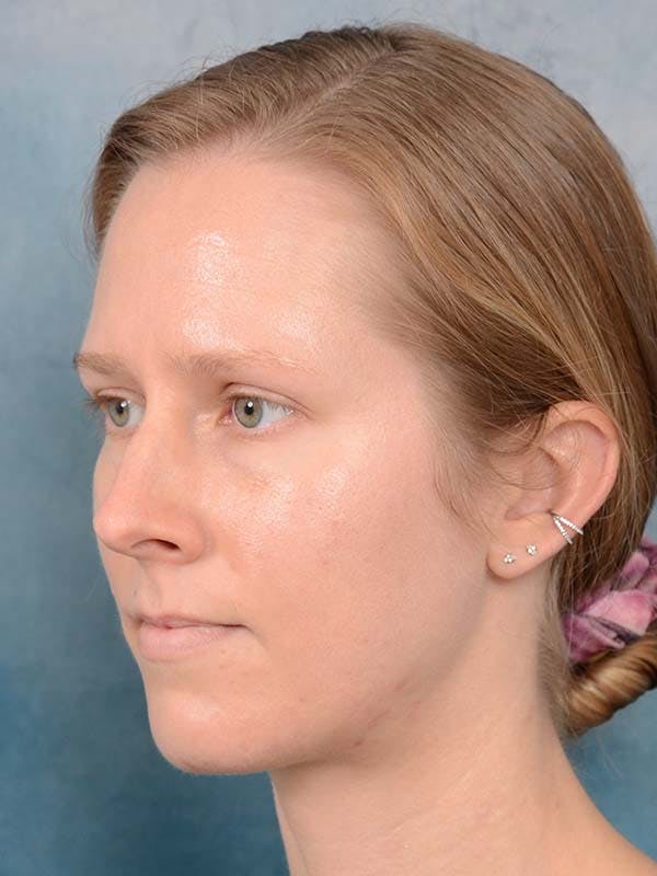 Rhinoplasty Before & After Gallery - Patient 121959740 - Image 9