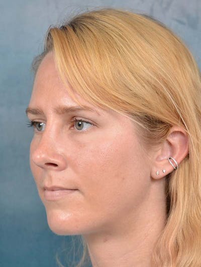Rhinoplasty Before & After Gallery - Patient 121959740 - Image 10