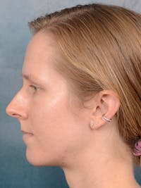 Rhinoplasty Before & After Gallery - Patient 121959740 - Image 1