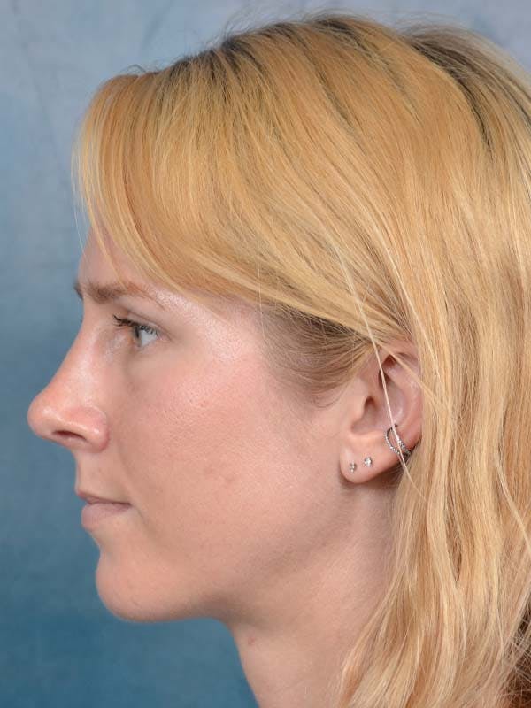 Rhinoplasty Before & After Gallery - Patient 121959740 - Image 2