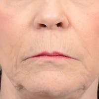 Lip Lift Before & After Gallery - Patient 121958832 - Image 1