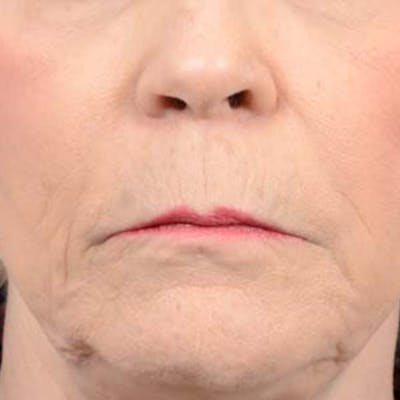 Lip Lift Before & After Gallery - Patient 121958832 - Image 1