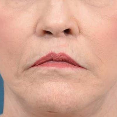Lip Lift Before & After Gallery - Patient 121958832 - Image 2