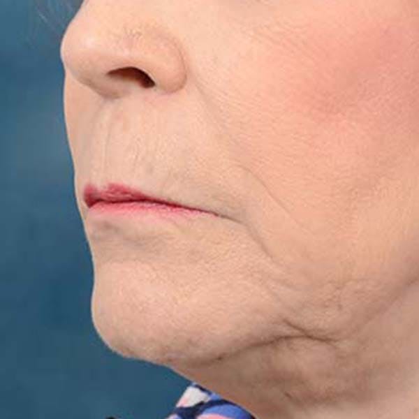 Lip Lift Before & After Gallery - Patient 121958832 - Image 3