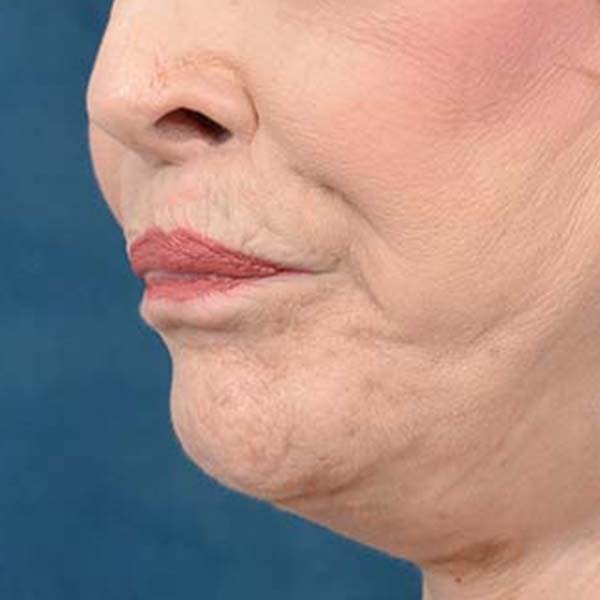 Lip Lift Before & After Gallery - Patient 121958832 - Image 4