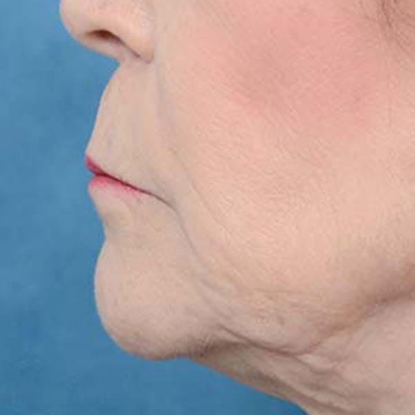 Lip Lift Before & After Gallery - Patient 121958832 - Image 5