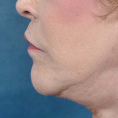 Lip Lift Before & After Gallery - Patient 121958832 - Image 6