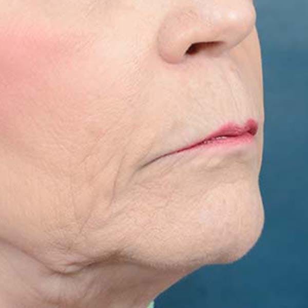 Lip Lift Before & After Gallery - Patient 121958832 - Image 7
