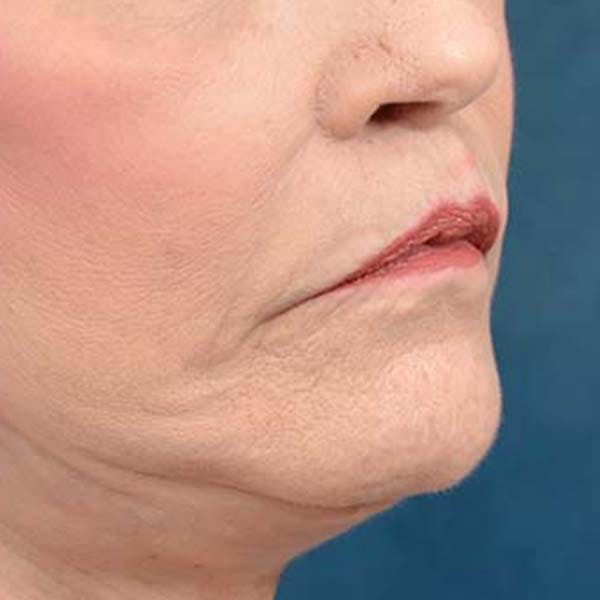 Lip Lift Before & After Gallery - Patient 121958832 - Image 8