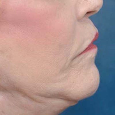Lip Lift Before & After Gallery - Patient 121958832 - Image 10