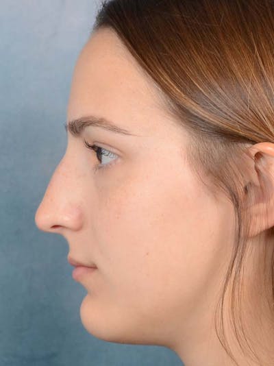 Rhinoplasty Before & After Gallery - Patient 122107789 - Image 1