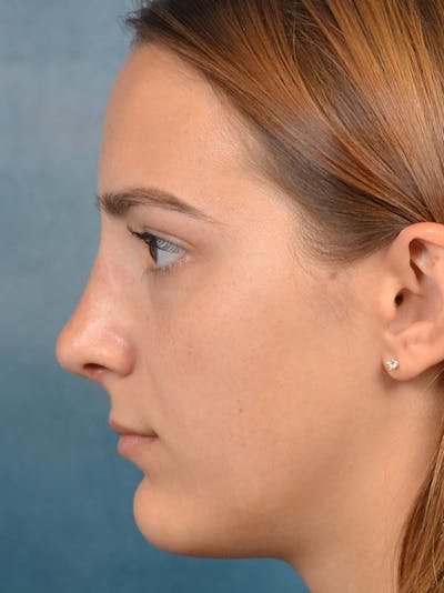Rhinoplasty Before & After Gallery - Patient 122107789 - Image 2