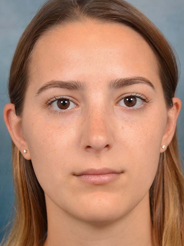 Rhinoplasty Before & After Gallery - Patient 122107789 - Image 4