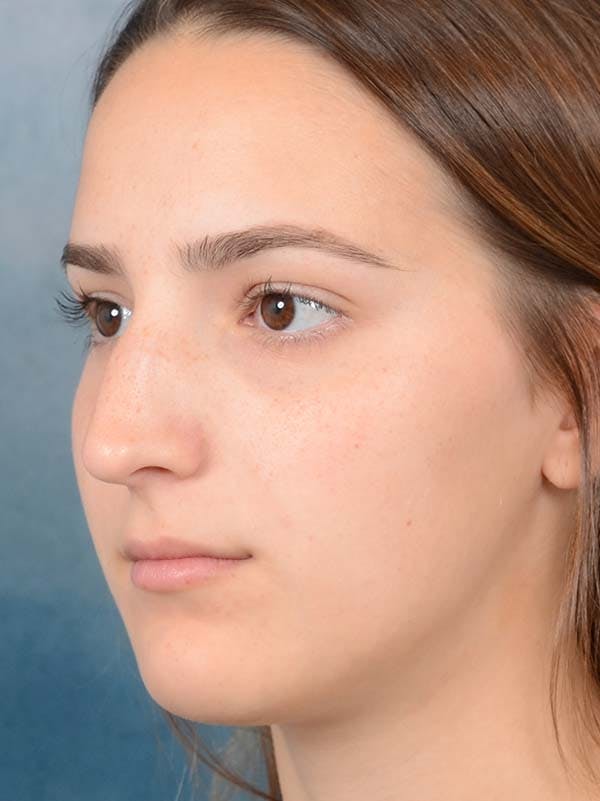 Rhinoplasty Before & After Gallery - Patient 122107789 - Image 5