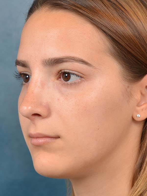 Rhinoplasty Before & After Gallery - Patient 122107789 - Image 6