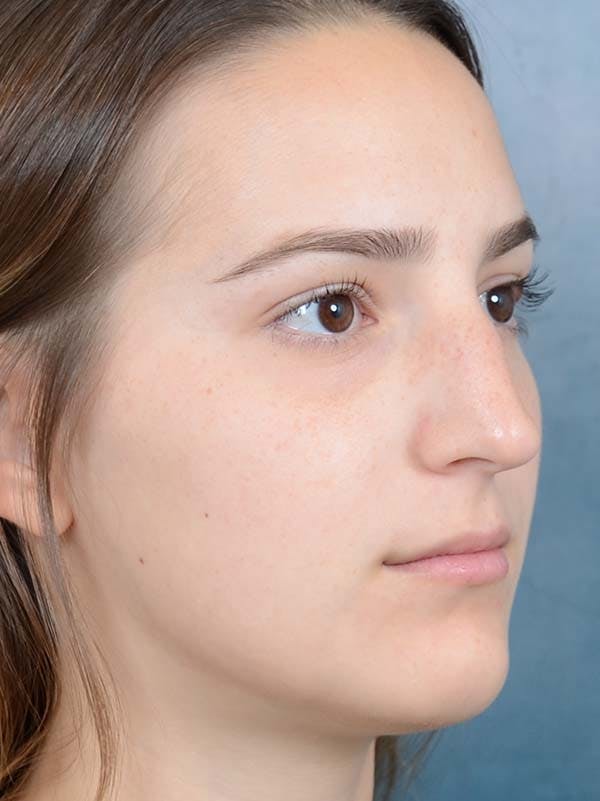Rhinoplasty Before & After Gallery - Patient 122107789 - Image 7