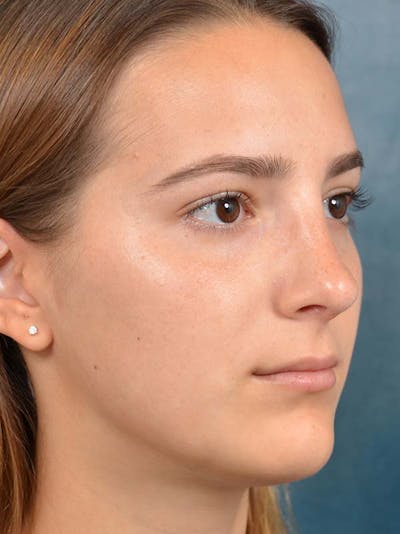 Rhinoplasty Before & After Gallery - Patient 122107789 - Image 8