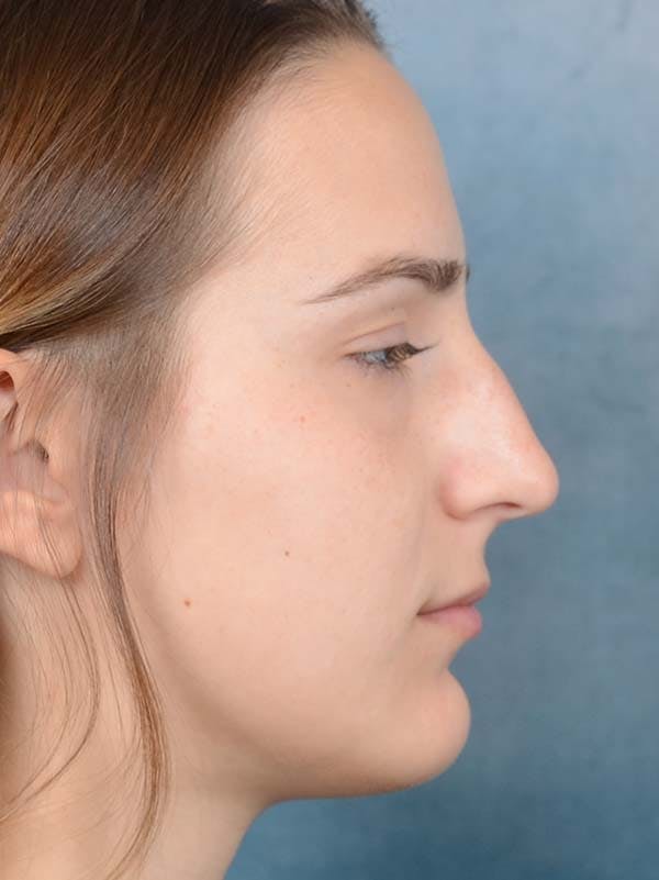 Rhinoplasty Before & After Gallery - Patient 122107789 - Image 9