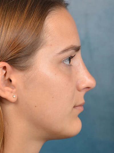 Rhinoplasty Before & After Gallery - Patient 122107789 - Image 10