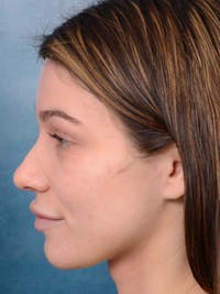 Rhinoplasty Before & After Gallery - Patient 122342725 - Image 1