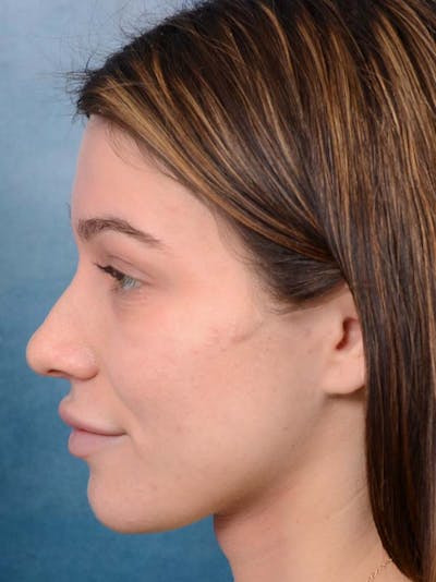 Rhinoplasty Before & After Gallery - Patient 122342725 - Image 1