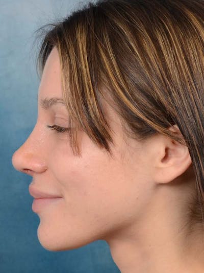 Rhinoplasty Before & After Gallery - Patient 122342725 - Image 2