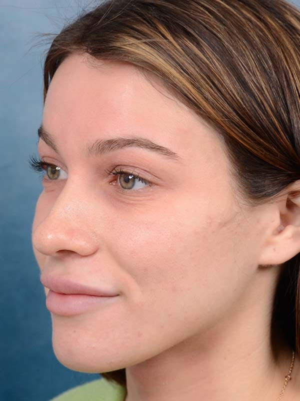Rhinoplasty Before & After Gallery - Patient 122342725 - Image 5