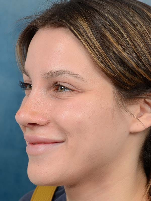 Rhinoplasty Before & After Gallery - Patient 122342725 - Image 6