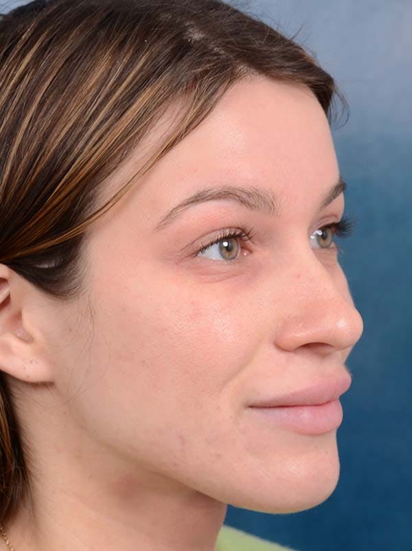 Rhinoplasty Before & After Gallery - Patient 122342725 - Image 7