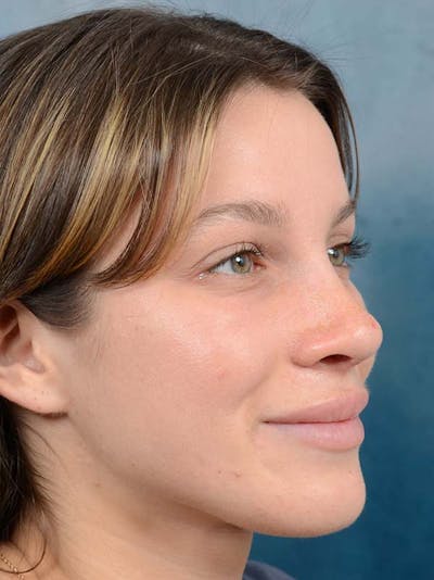 Rhinoplasty Before & After Gallery - Patient 122342725 - Image 8