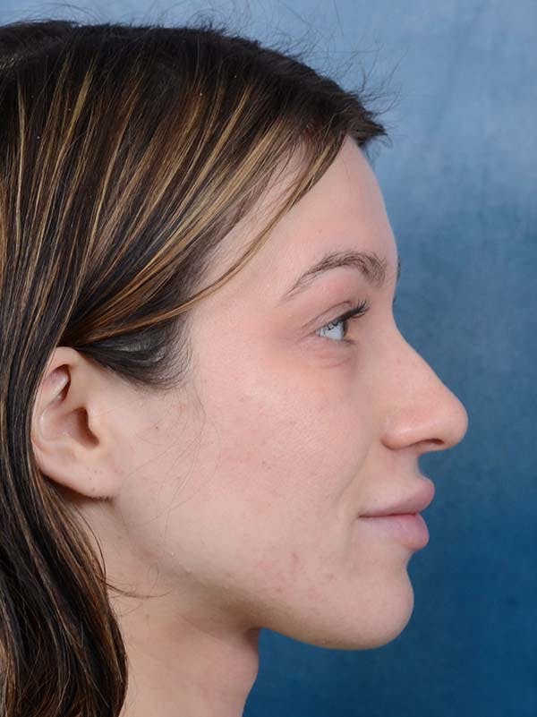 Rhinoplasty Before & After Gallery - Patient 122342725 - Image 9