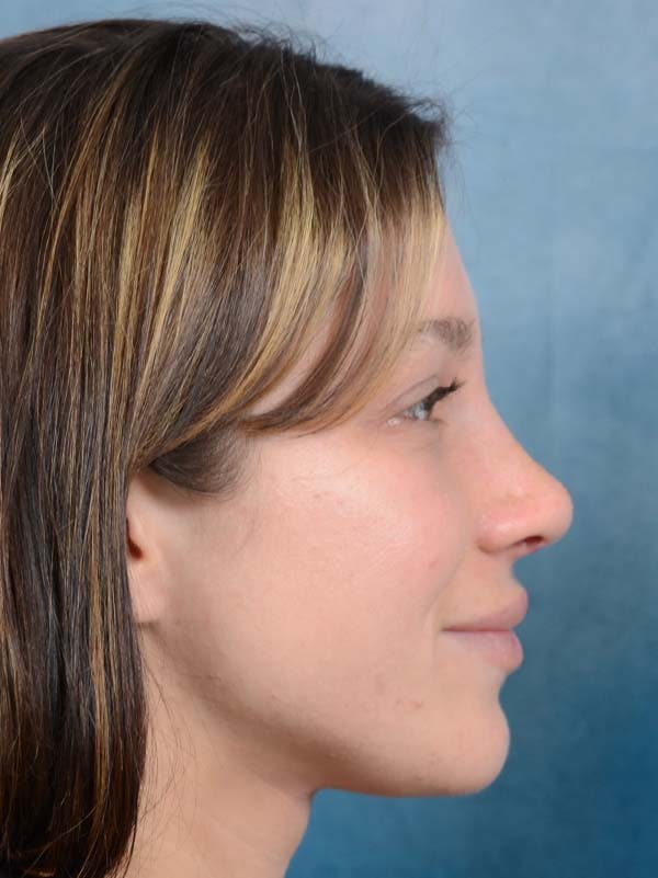 Rhinoplasty Before & After Gallery - Patient 122342725 - Image 10