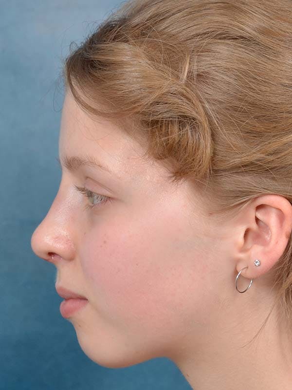 Rhinoplasty Before & After Gallery - Patient 122342909 - Image 2