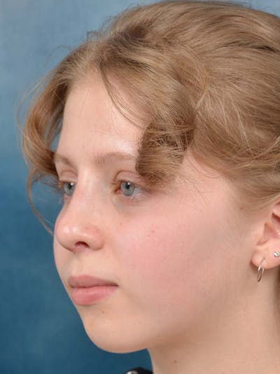 Rhinoplasty Before & After Gallery - Patient 122342909 - Image 4