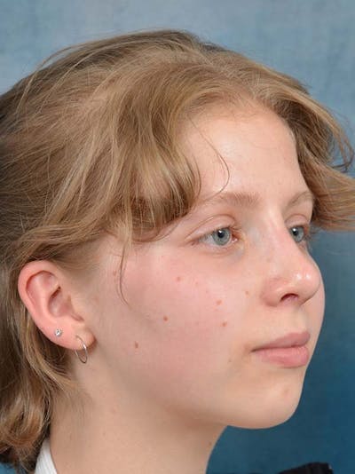Rhinoplasty Before & After Gallery - Patient 122342909 - Image 8