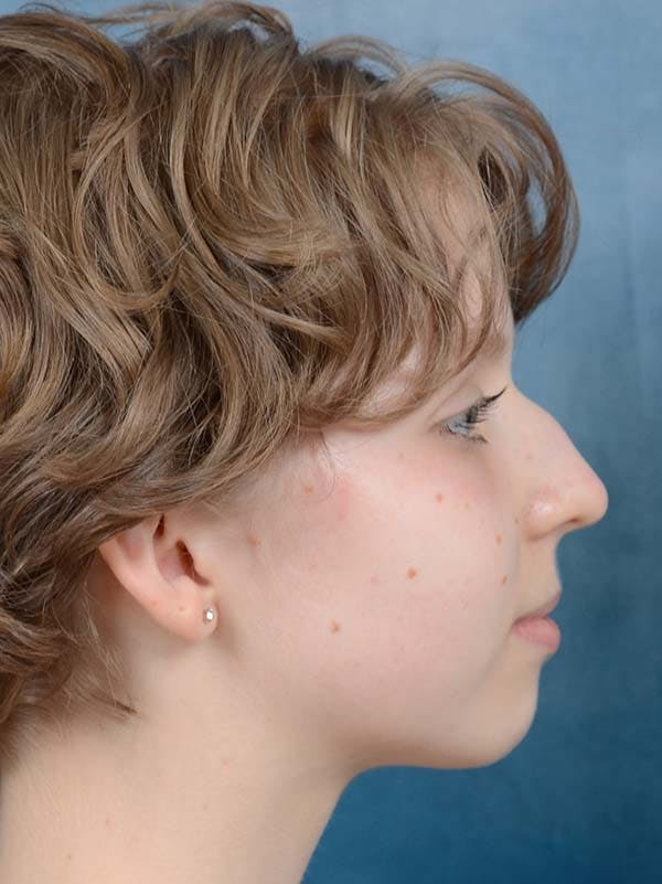 Rhinoplasty Before & After Gallery - Patient 122342909 - Image 9