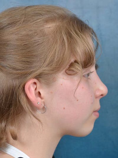 Rhinoplasty Before & After Gallery - Patient 122342909 - Image 10