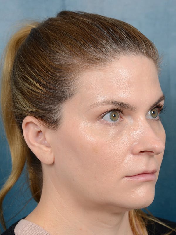 Rhinoplasty Before & After Gallery - Patient 122404061 - Image 5