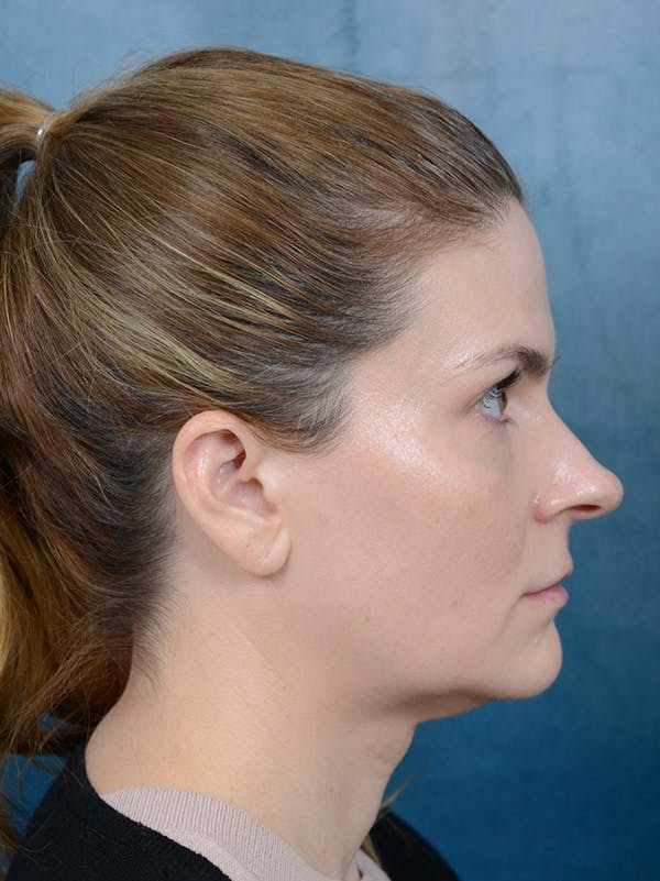 Rhinoplasty Before & After Gallery - Patient 122404061 - Image 7