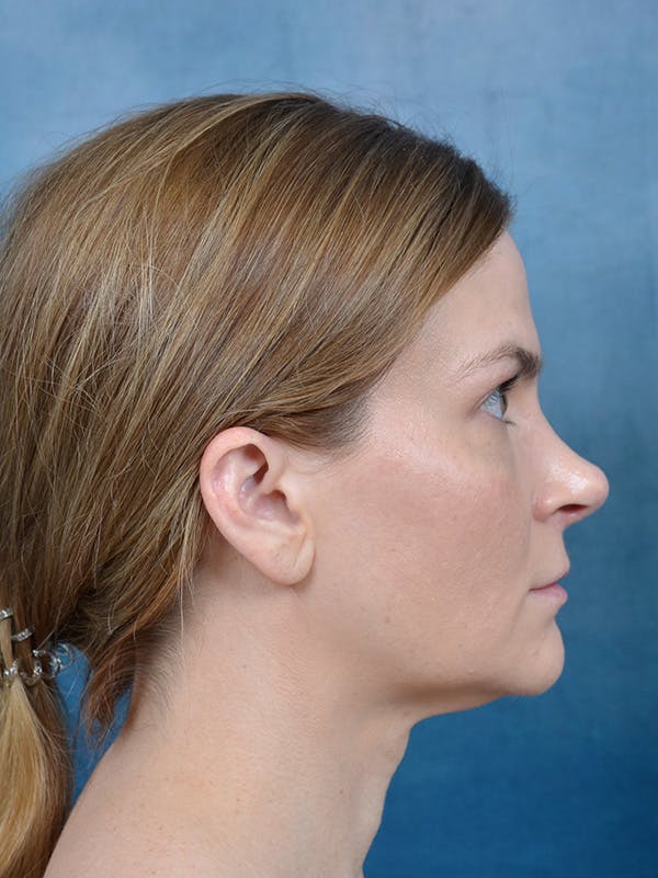 Rhinoplasty Before & After Gallery - Patient 122404061 - Image 8