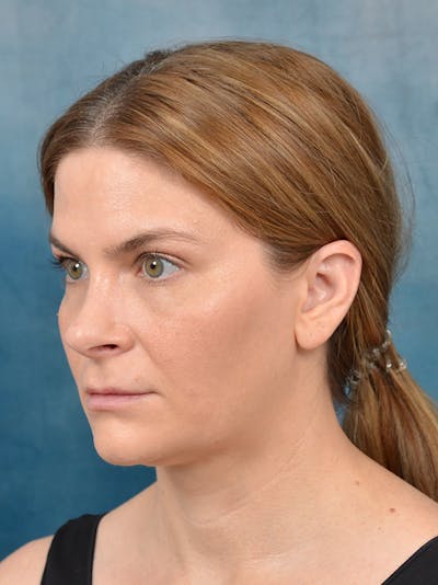 Rhinoplasty Before & After Gallery - Patient 122404061 - Image 10