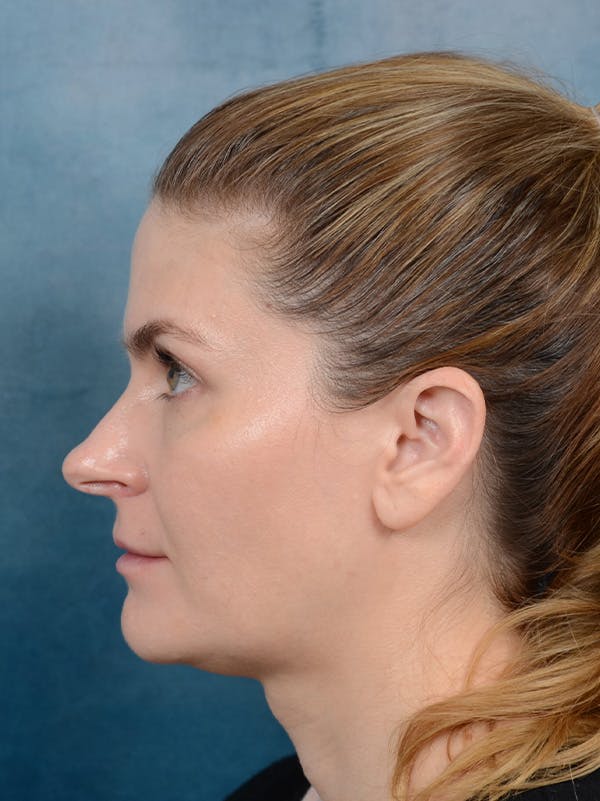 Rhinoplasty Before & After Gallery - Patient 122404061 - Image 1