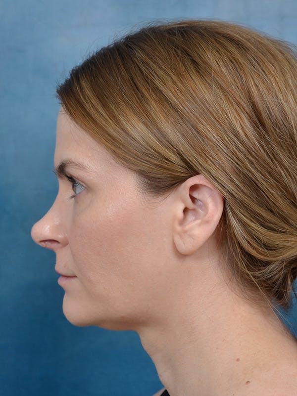 Rhinoplasty Before & After Gallery - Patient 122404061 - Image 2
