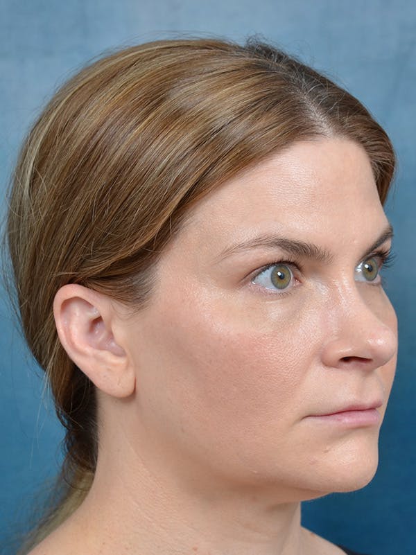 Rhinoplasty Before & After Gallery - Patient 122404061 - Image 6