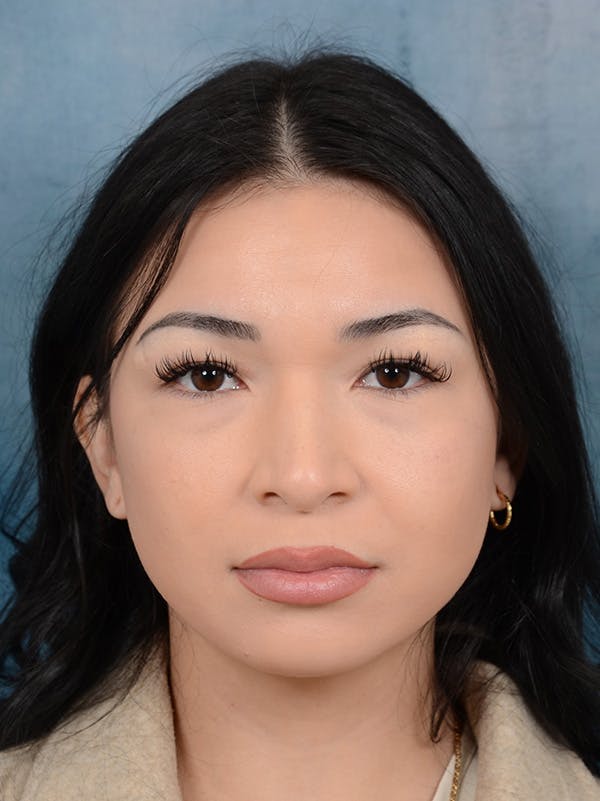 Rhinoplasty Before & After Gallery - Patient 122749877 - Image 3