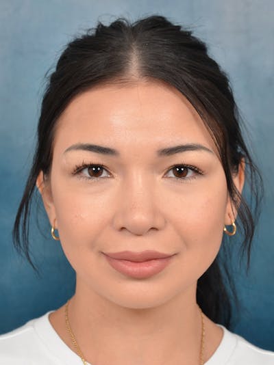 Rhinoplasty Before & After Gallery - Patient 122749877 - Image 4