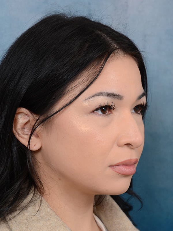 Rhinoplasty Before & After Gallery - Patient 122749877 - Image 5